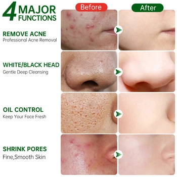 Маска за почистване на лицето, контрол на масло, хидратиращ почистване, гел за лечение на акне, сужающий порите, средство за премахване на черни точки, възстановяващ кожата грижи за 10 бр.